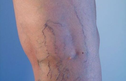 proširene vene na nogama kod žena