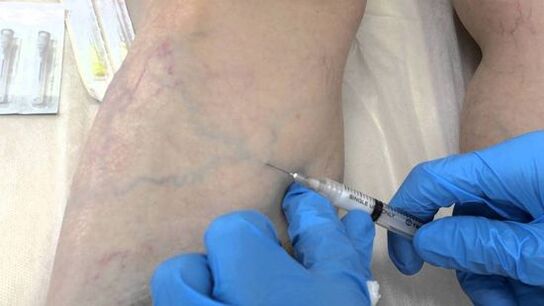 skleroterapija proširenih vena na nogama kod žena