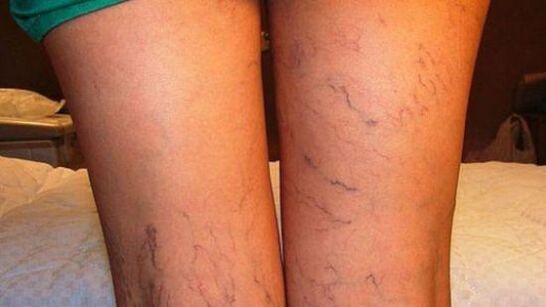 vene na nogama sa proširenim venama